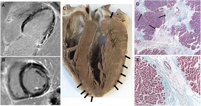 The cardiomyopathy of cystic fibrosis: a modern form of Keshan disease